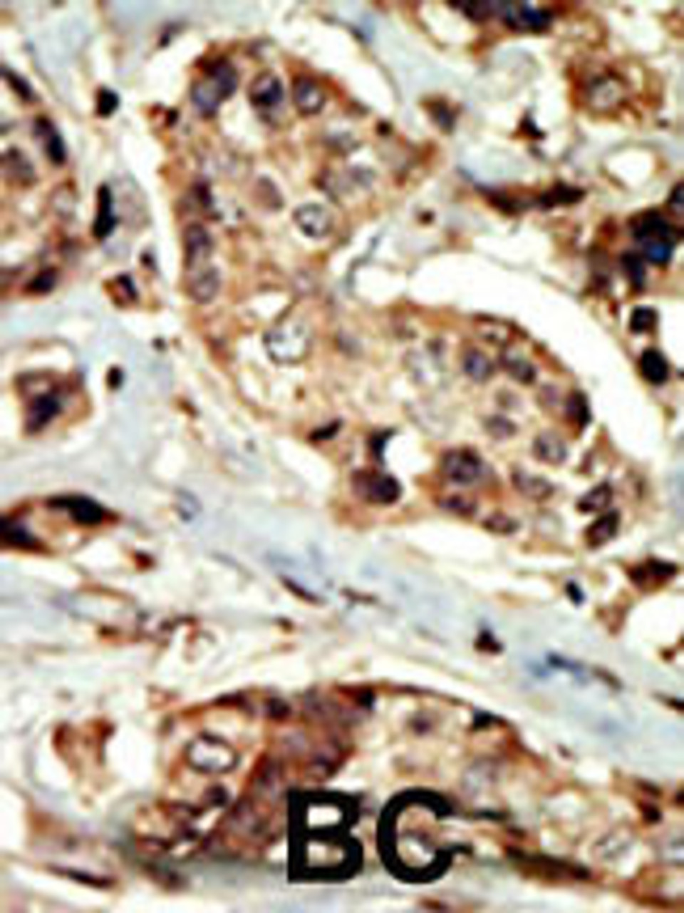 Formalin-fixed and paraffin-embedded human cancer tissue reacted with the primary antibody, which was peroxidase-conjugated to the secondary antibody, followed by DAB staining. BC = breast carcinoma; HC = hepatocarcinoma.