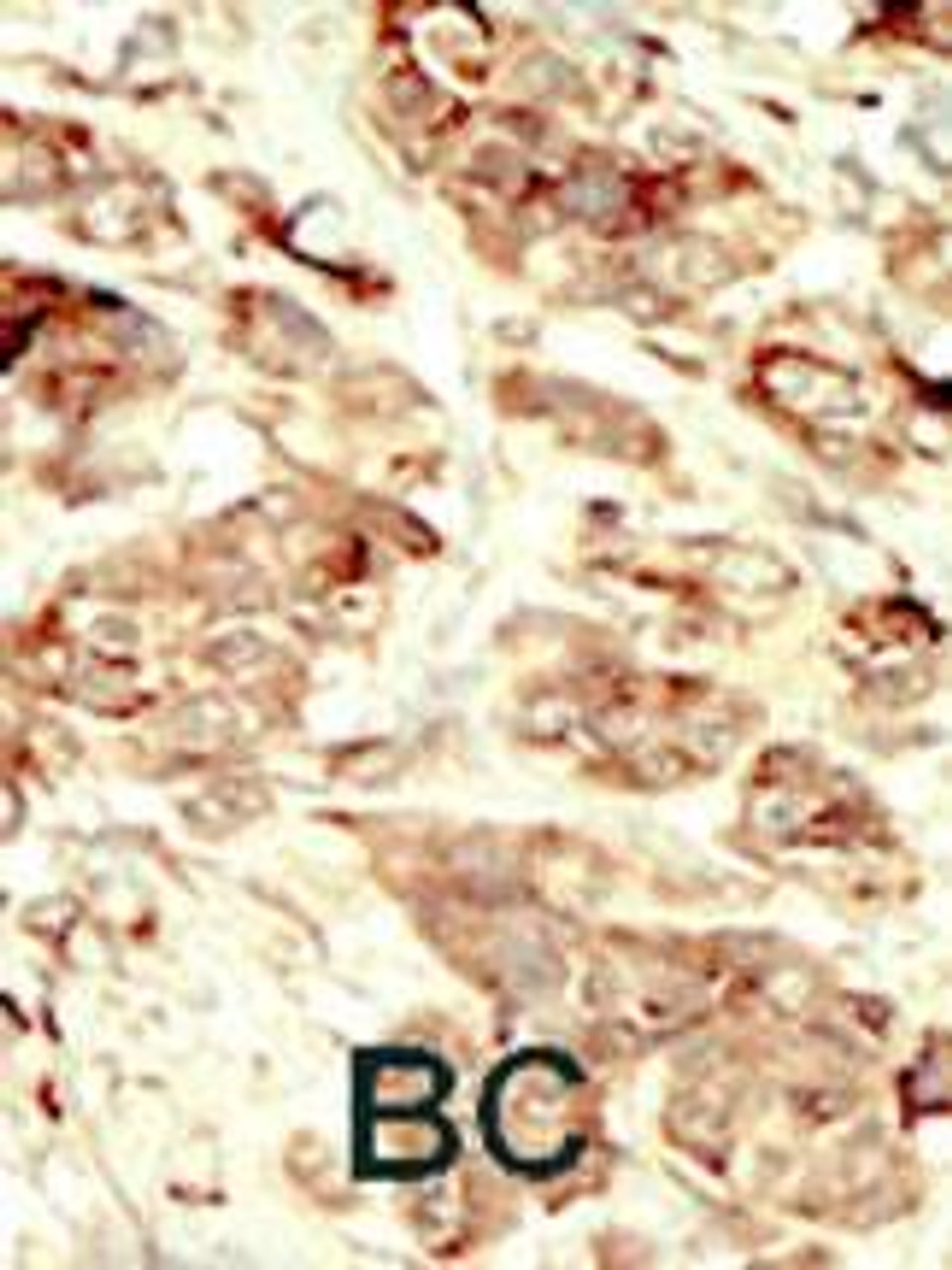 Formalin-fixed and paraffin-embedded human cancer tissue reacted with the primary antibody, which was peroxidase-conjugated to the secondary antibody, followed by DAB staining. BC = breast carcinoma; HC = hepatocarcinoma.