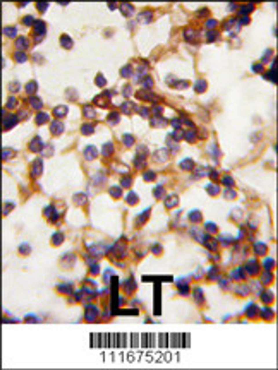 Formalin-fixed and paraffin-embedded human Lymph tissue reacted with Rictor antibody (N-term) , which was peroxidase-conjugated to the secondary antibody, followed by DAB staining.