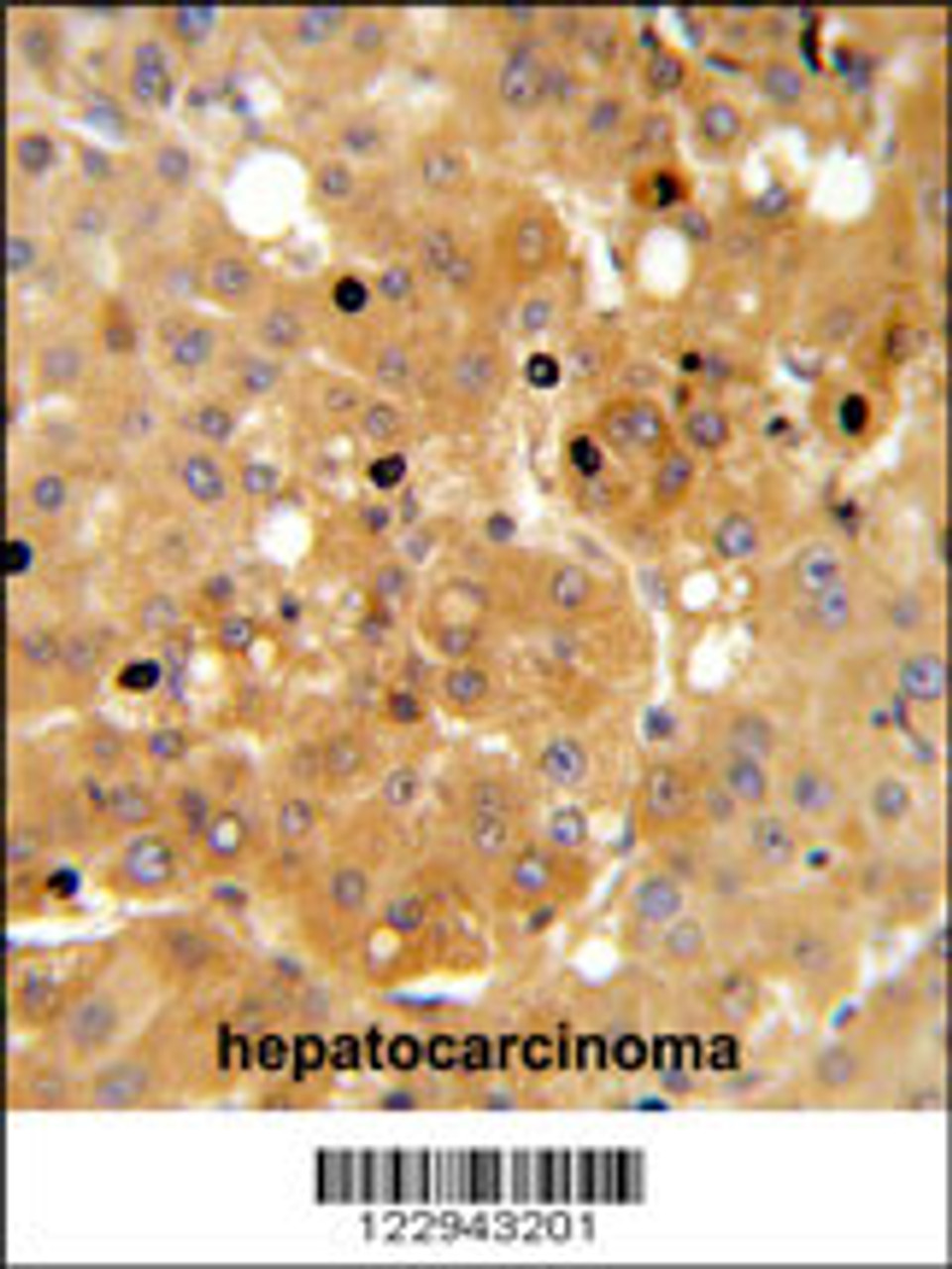 PRKAA1 Antibody IHC analysis in formalin fixed and paraffin embedded human hepatocarcinoma followed by peroxidase conjugation of the secondary antibody and DAB staining.