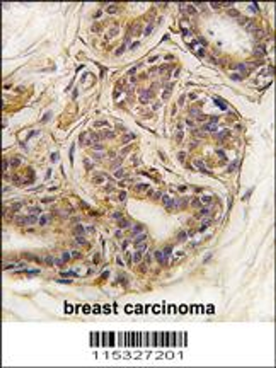 Formalin-fixed and paraffin-embedded human breast carcinoma tissue reacted with CASC3 Antibody (Y181) , which was peroxidase-conjugated to the secondary antibody, followed by DAB staining.