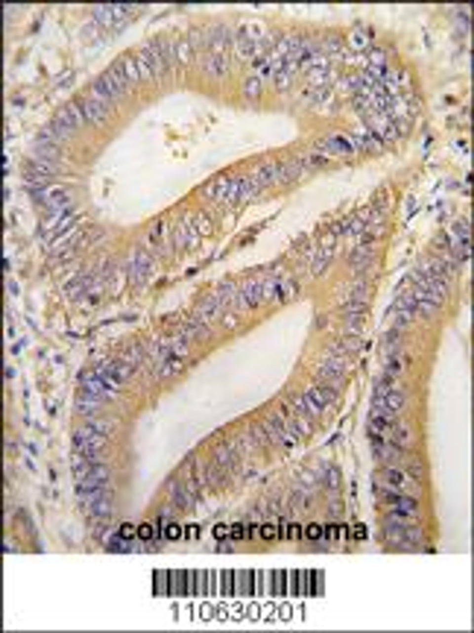 Formalin-fixed and paraffin-embedded human colon carcinoma tissue reacted with PHB2 Antibody, which was peroxidase-conjugated to the secondary antibody, followed by DAB staining.