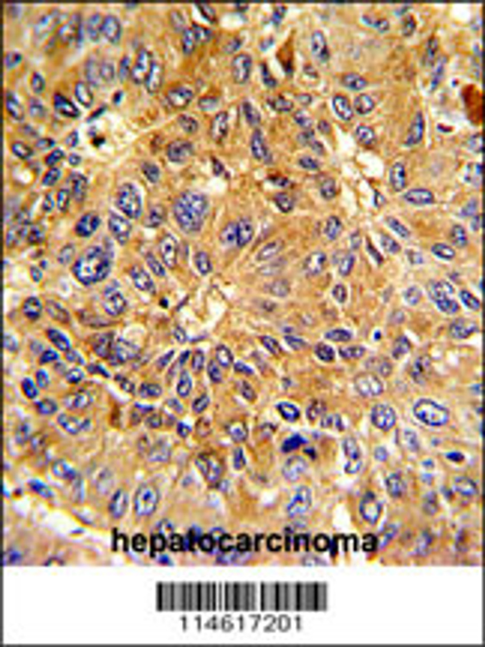 Formalin-fixed and paraffin-embedded human hepatocarcinoma with Cyclin A (CCNA2) Antibody (N-term) , which was peroxidase-conjugated to the secondary antibody, followed by DAB staining.