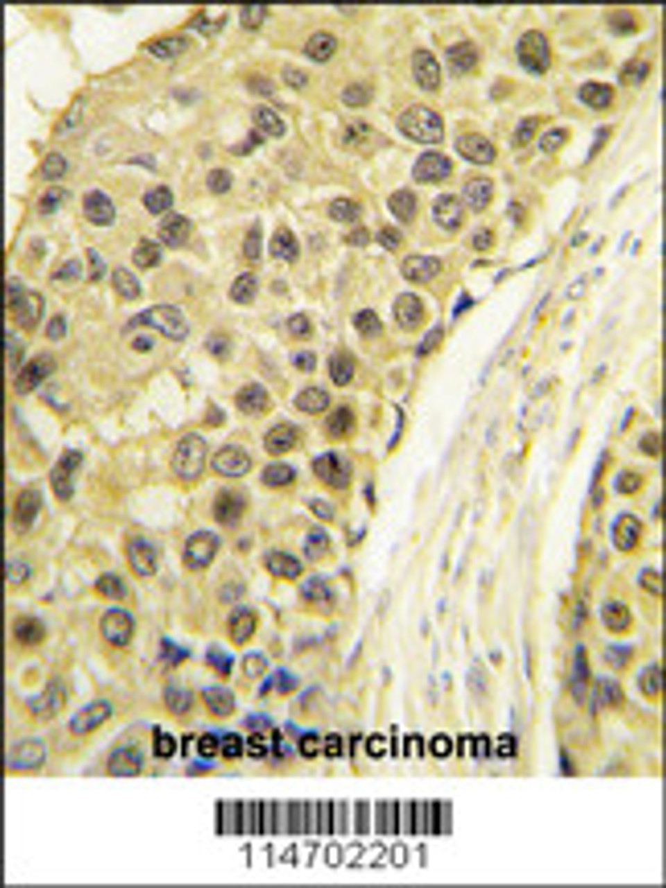 Formalin-fixed and paraffin-embedded human breast carcinoma tissue reacted with CCNA2 antibody, which was peroxidase-conjugated to the secondary antibody, followed by DAB staining.