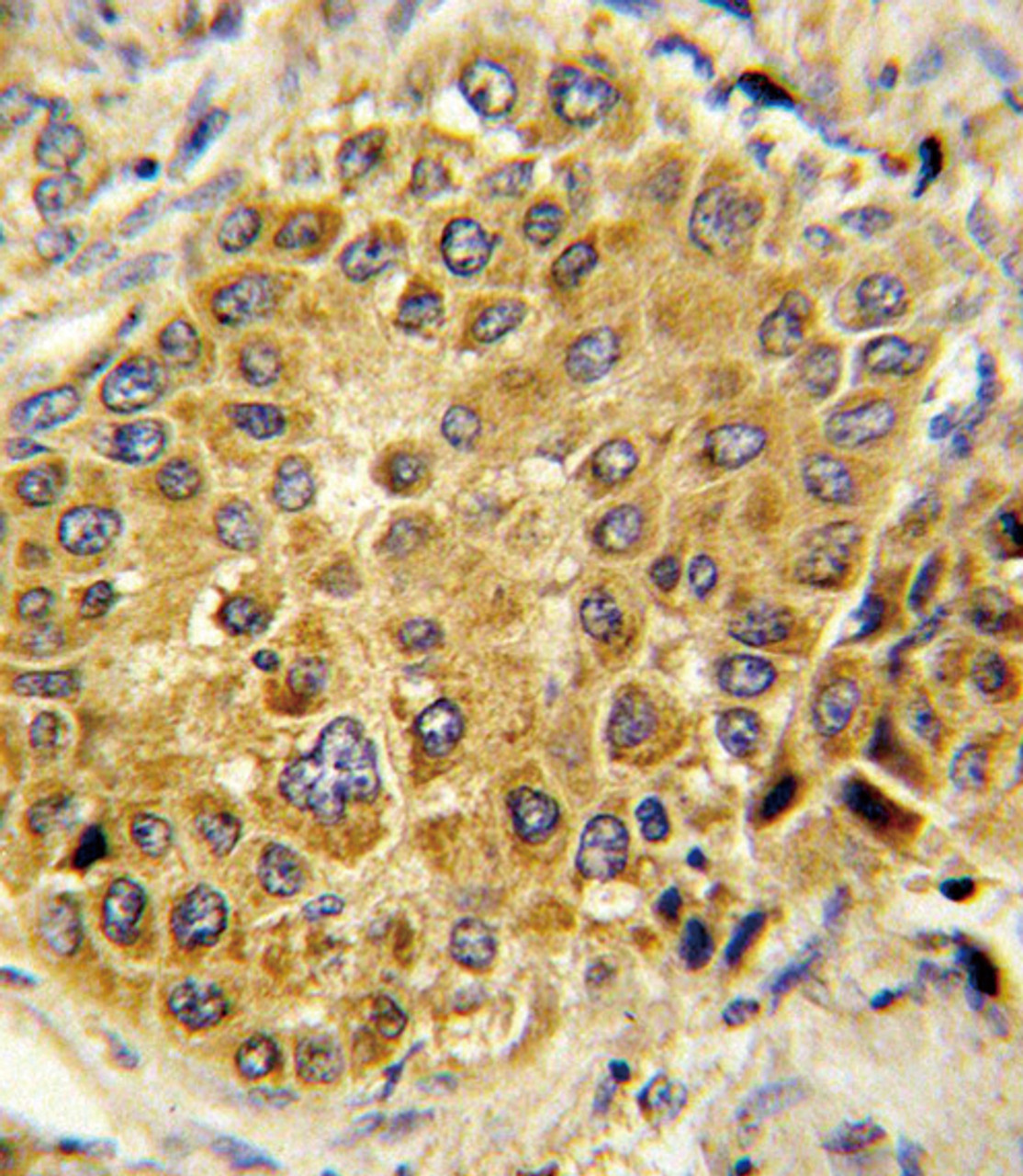 Formalin-fixed and paraffin-embedded human hepatocarcinoma reacted with PLG Antibody, which was peroxidase-conjugated to the secondary antibody, followed by DAB staining.