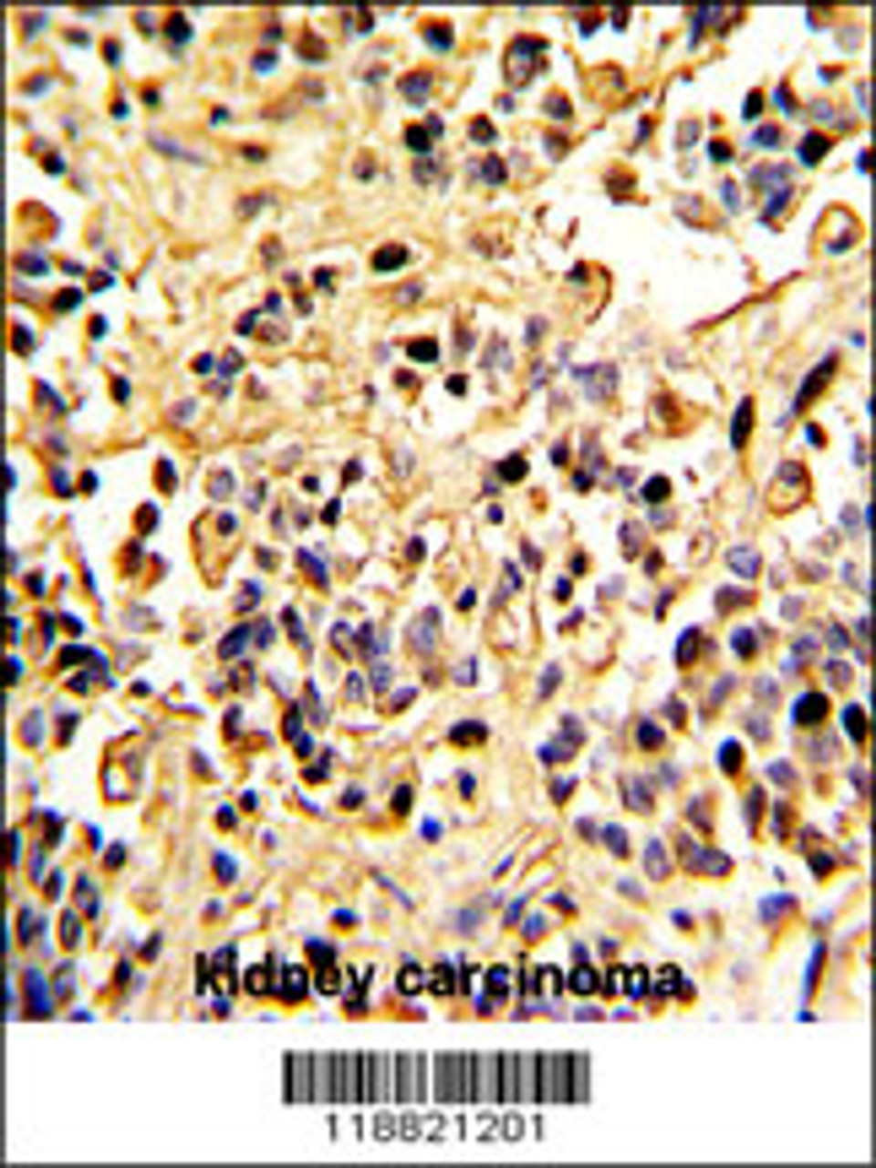 Formalin-fixed and paraffin-embedded human kidney carcinoma with Neprilysin Antibody, which was peroxidase-conjugated to the secondary antibody, followed by DAB staining.