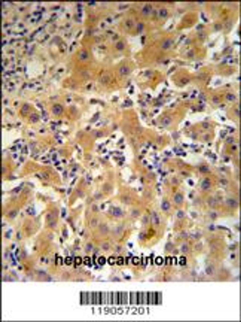 CP Antibody IHC analysis in formalin fixed and paraffin embedded human hepatocarcinoma followed by peroxidase conjugation of the secondary antibody and DAB staining.