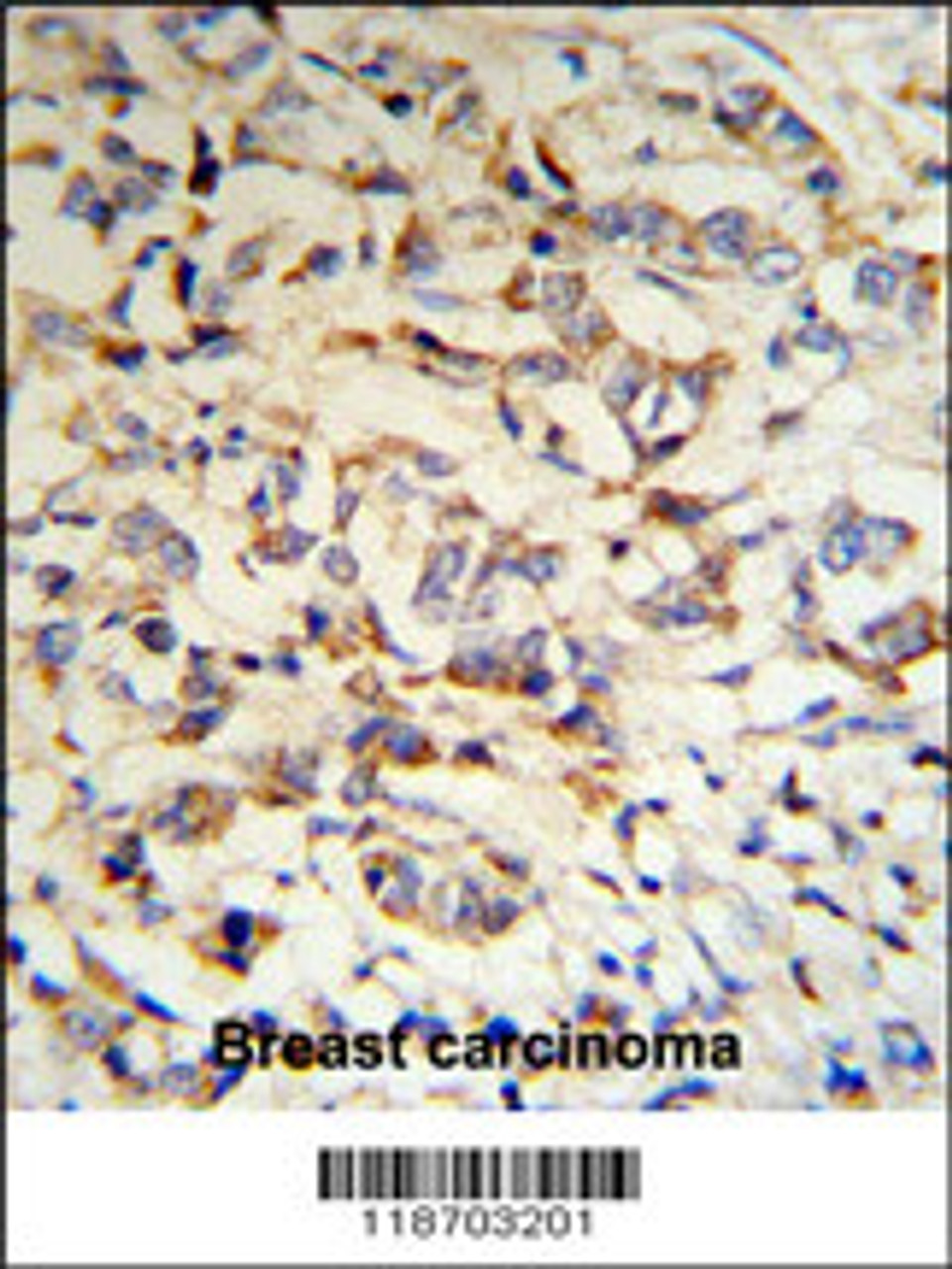 CPN2 Antibody (RB18703) IHC analysis in formalin fixed and paraffin embedded human breast carcinoma tissue followed by peroxidase conjugation of the secondary antibody and DAB staining.