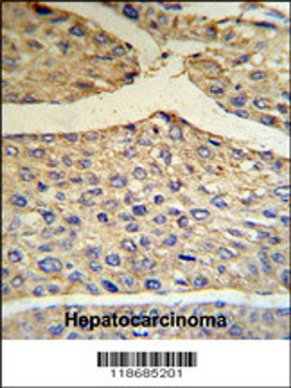 BF Antibody IHC analysis in formalin fixed and paraffin embedded human hepatocarcinoma tissue followed by peroxidase conjugation of the secondary antibody and DAB staining.