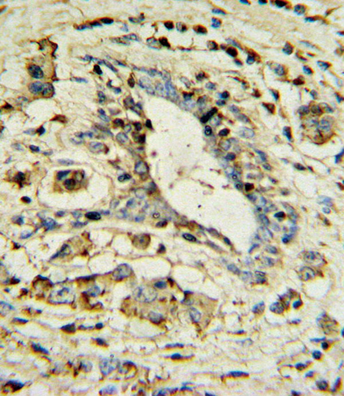 APOL1 Antibody IHC analysis in formalin fixed and paraffin embedded human breast carcinoma followed by peroxidase conjugation of the secondary antibody and DAB staining.