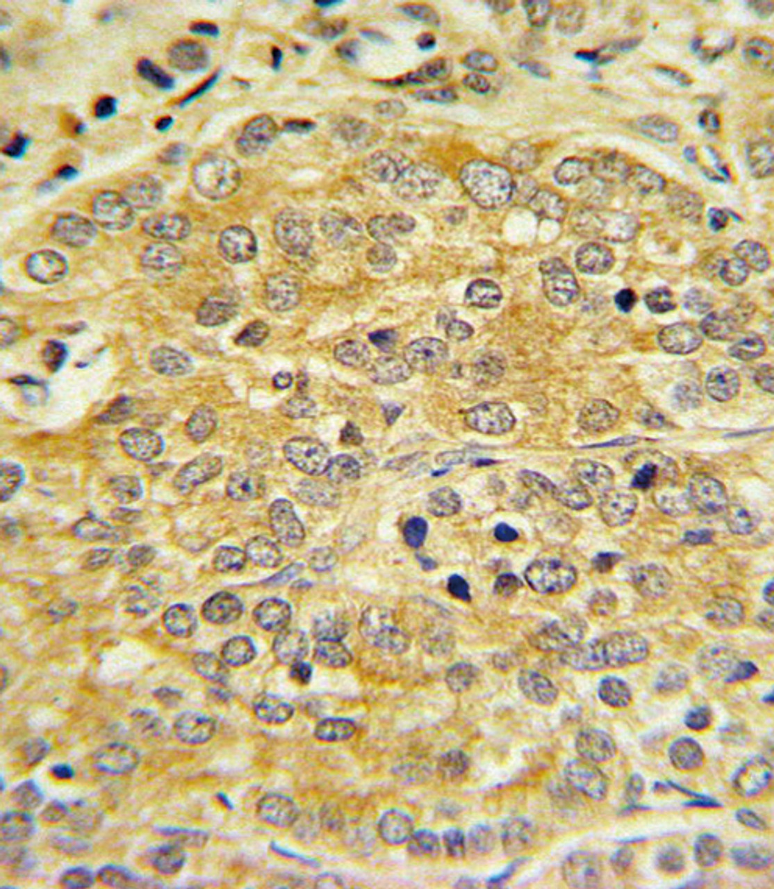 APOL1 Antibody IHC analysis in formalin fixed and paraffin embedded human Prostate carcinoma followed by peroxidase conjugation of the secondary antibody and DAB staining.