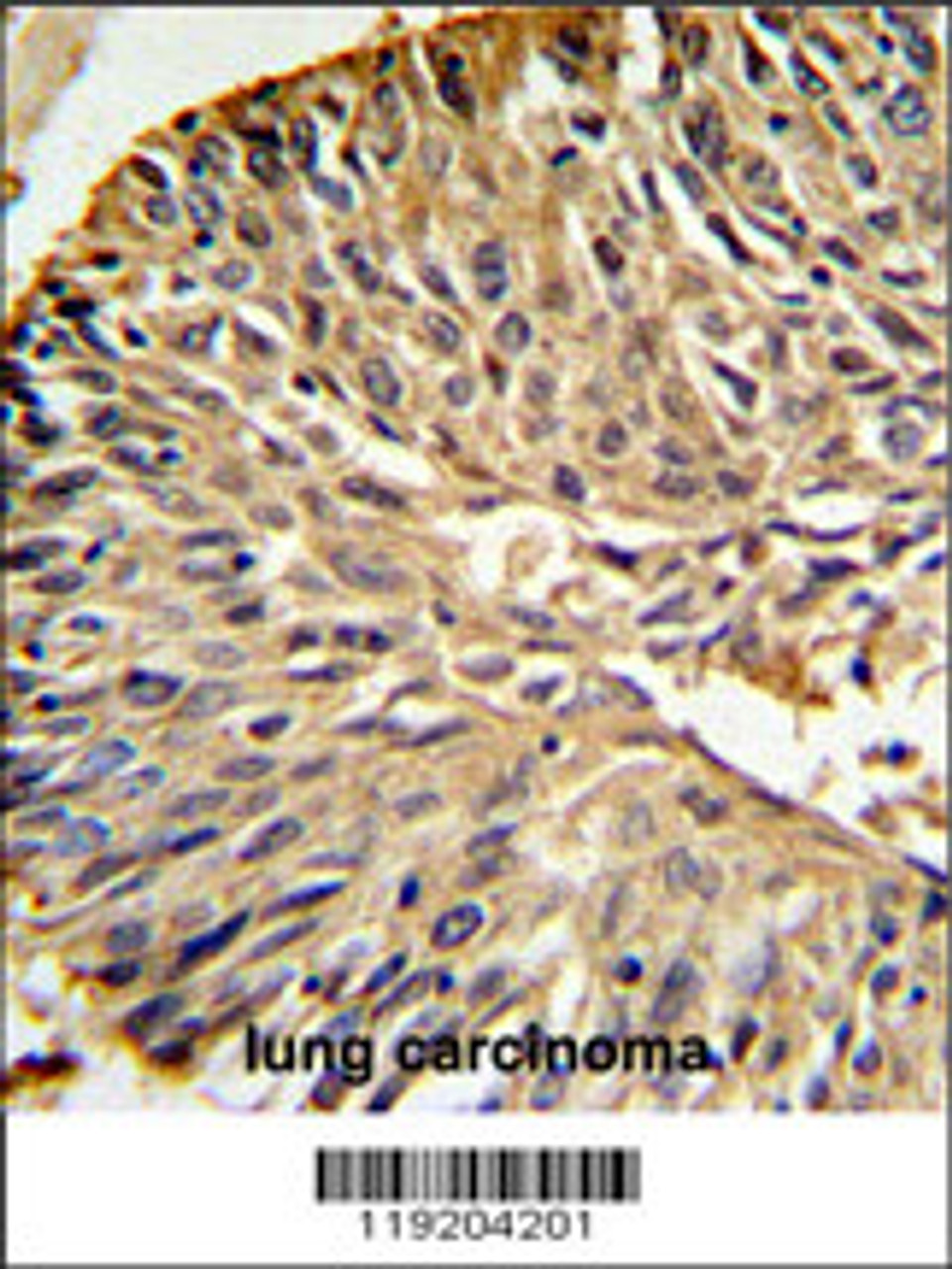 DHFR Antibody IHC analysis in formalin fixed and paraffin embedded human lung carcinoma followed by peroxidase conjugation of the secondary antibody and DAB staining.