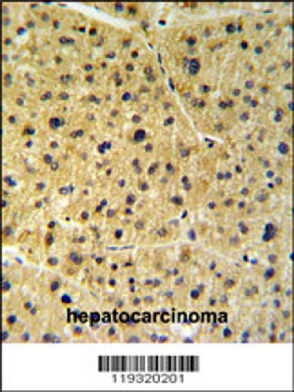 FKBP9 Antibody IHC analysis in formalin fixed and paraffin embedded human hepatocarcinoma followed by peroxidase conjugation of the secondary antibody and DAB staining.
