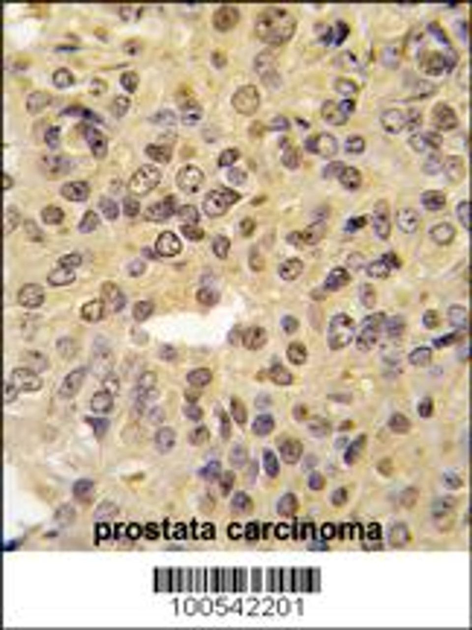 Formalin-fixed and paraffin-embedded human prostata carcinoma tissue reacted with MEN1 Antibody (S128) , which was peroxidase-conjugated to the secondary antibody, followed by DAB staining.