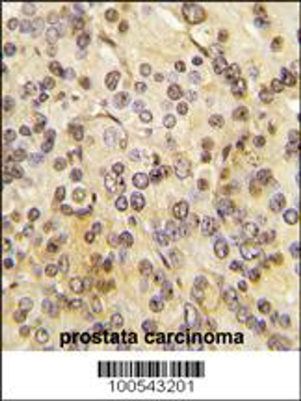 Formalin-fixed and paraffin-embedded human prostata carcinoma tissue reacted with MEN1 Antibody (T594) , which was peroxidase-conjugated to the secondary antibody, followed by DAB staining.