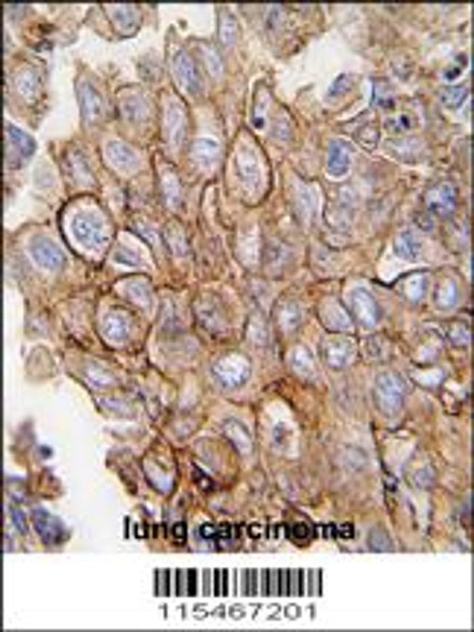 Formalin-fixed and paraffin-embedded human lung carcinoma tissue reacted with ANXA2 antibody, which was peroxidase-conjugated to the secondary antibody, followed by DAB staining.