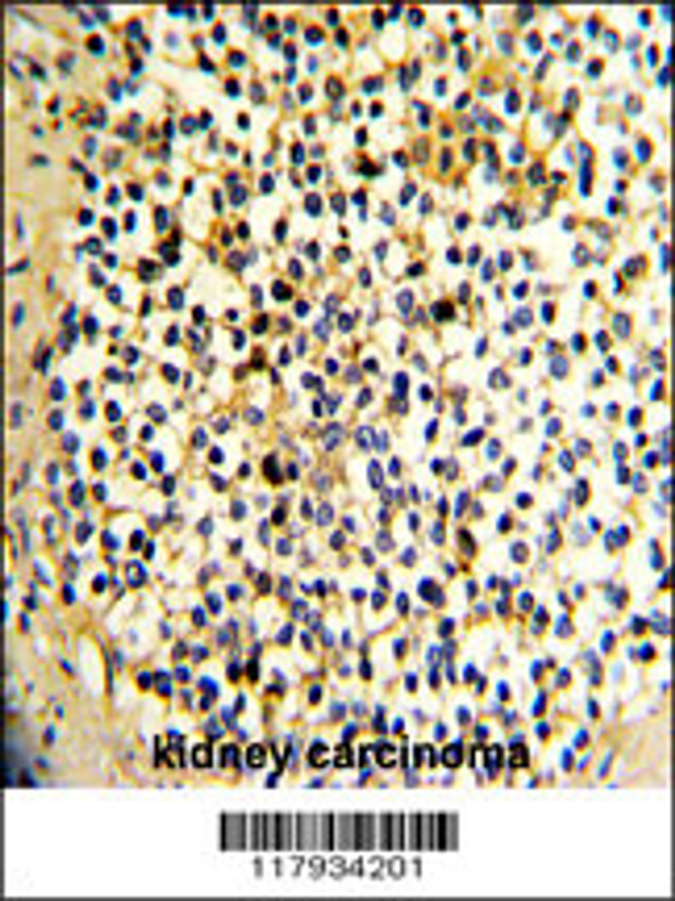 Formalin-fixed and paraffin-embedded human kidney carcinoma with DCXR Antibody, which was peroxidase-conjugated to the secondary antibody, followed by DAB staining.