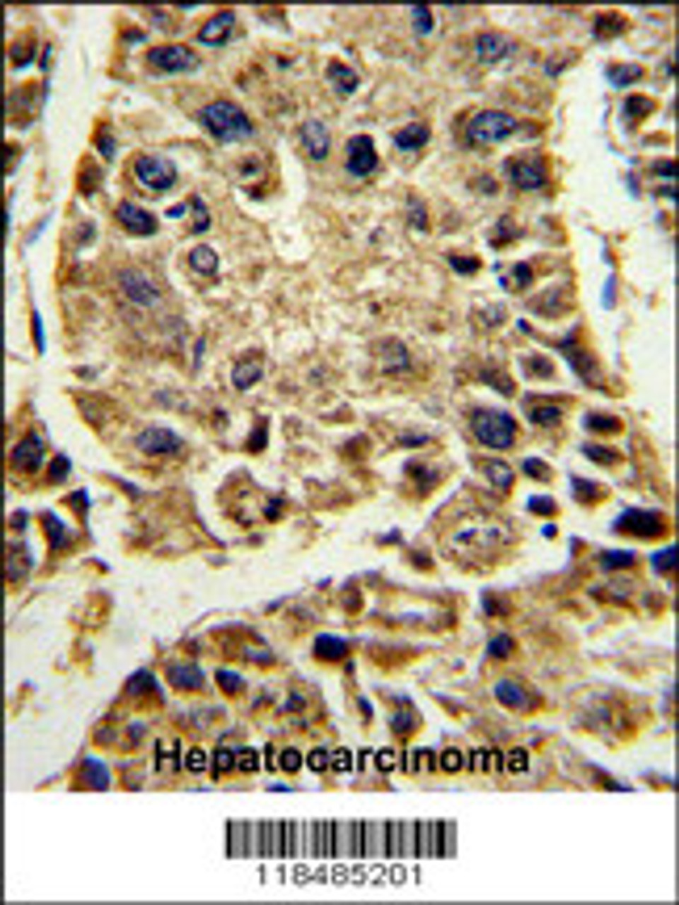 Formalin-fixed and paraffin-embedded human hepatocarcinoma reacted with SERPINA4 Antibody, which was peroxidase-conjugated to the secondary antibody, followed by DAB staining.