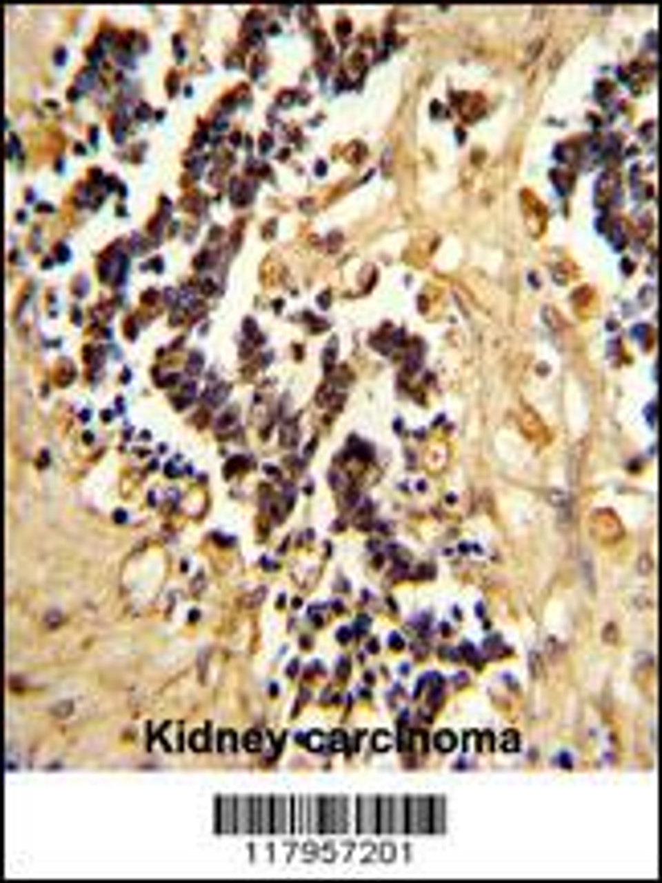 Formalin-fixed and paraffin-embedded human kidney carcinoma reacted with EHD3 Antibody, which was peroxidase-conjugated to the secondary antibody, followed by DAB staining.