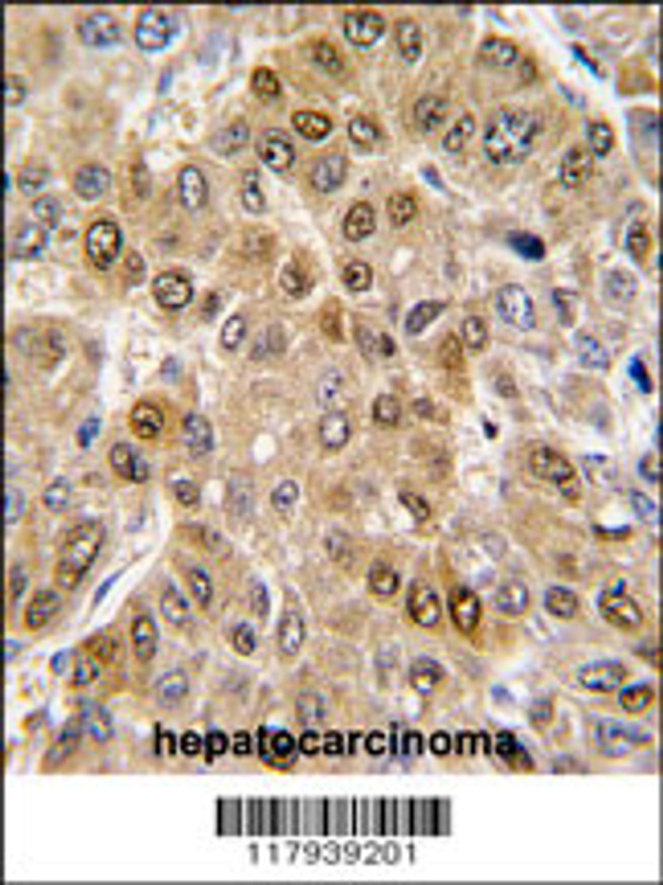 Formalin-fixed and paraffin-embedded human hepatocarcinoma tissue reacted with DDX5 antibody, which was peroxidase-conjugated to the secondary antibody, followed by DAB staining.