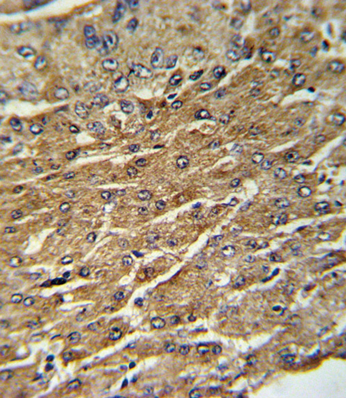 Formalin-fixed and paraffin-embedded human hepatocarcinoma wit, which was peroxidase-conjugated to the secondary antibody, followed by DAB staining.
