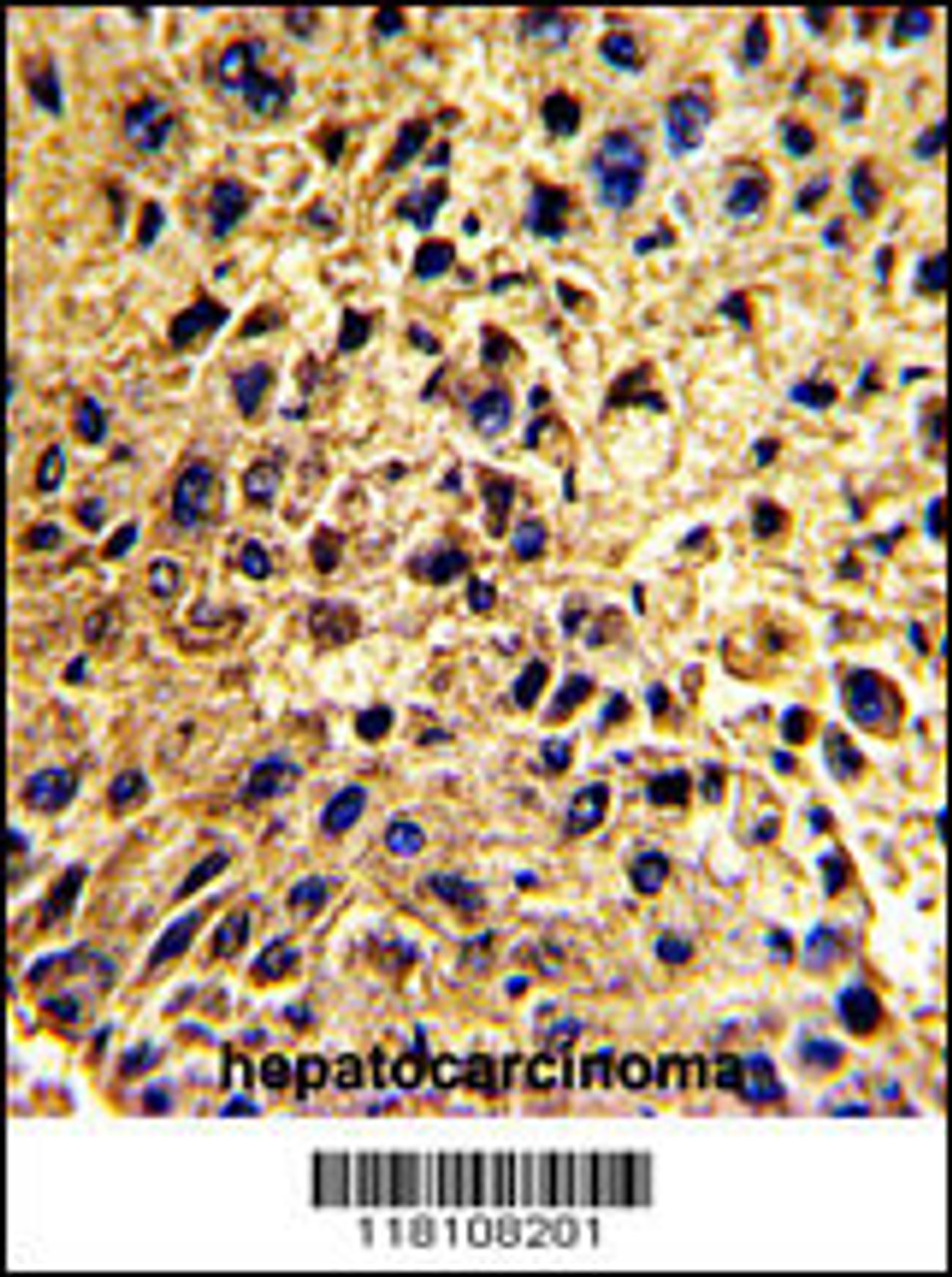 Formalin-fixed and paraffin-embedded human hepatocarcinoma with, which was peroxidase-conjugated to the secondary antibody, followed by DAB staining.