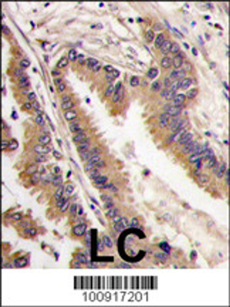 Formalin-fixed and paraffin-embedded human lung carcinoma tissue reacted with ERK4 antibody, which was peroxidase-conjugated to the secondary antibody, followed by DAB staining.