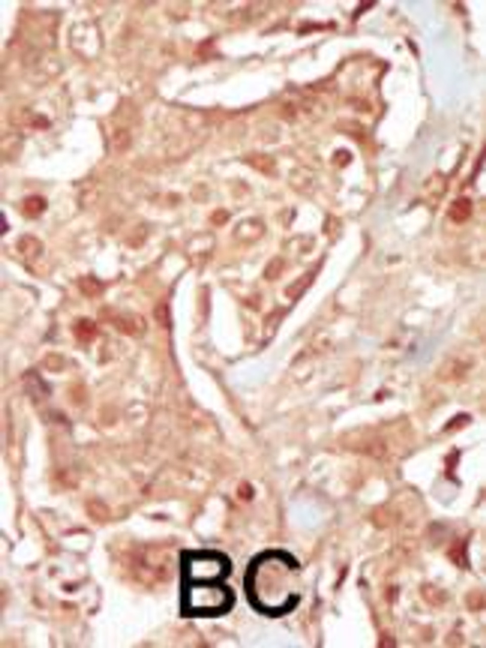 Formalin-fixed and paraffin-embedded human cancer tissue reacted with the primary antibody, which was peroxidase-conjugated to the secondary antibody, followed by DAB staining. BC = breast carcinoma; HC = hepatocarcinoma.