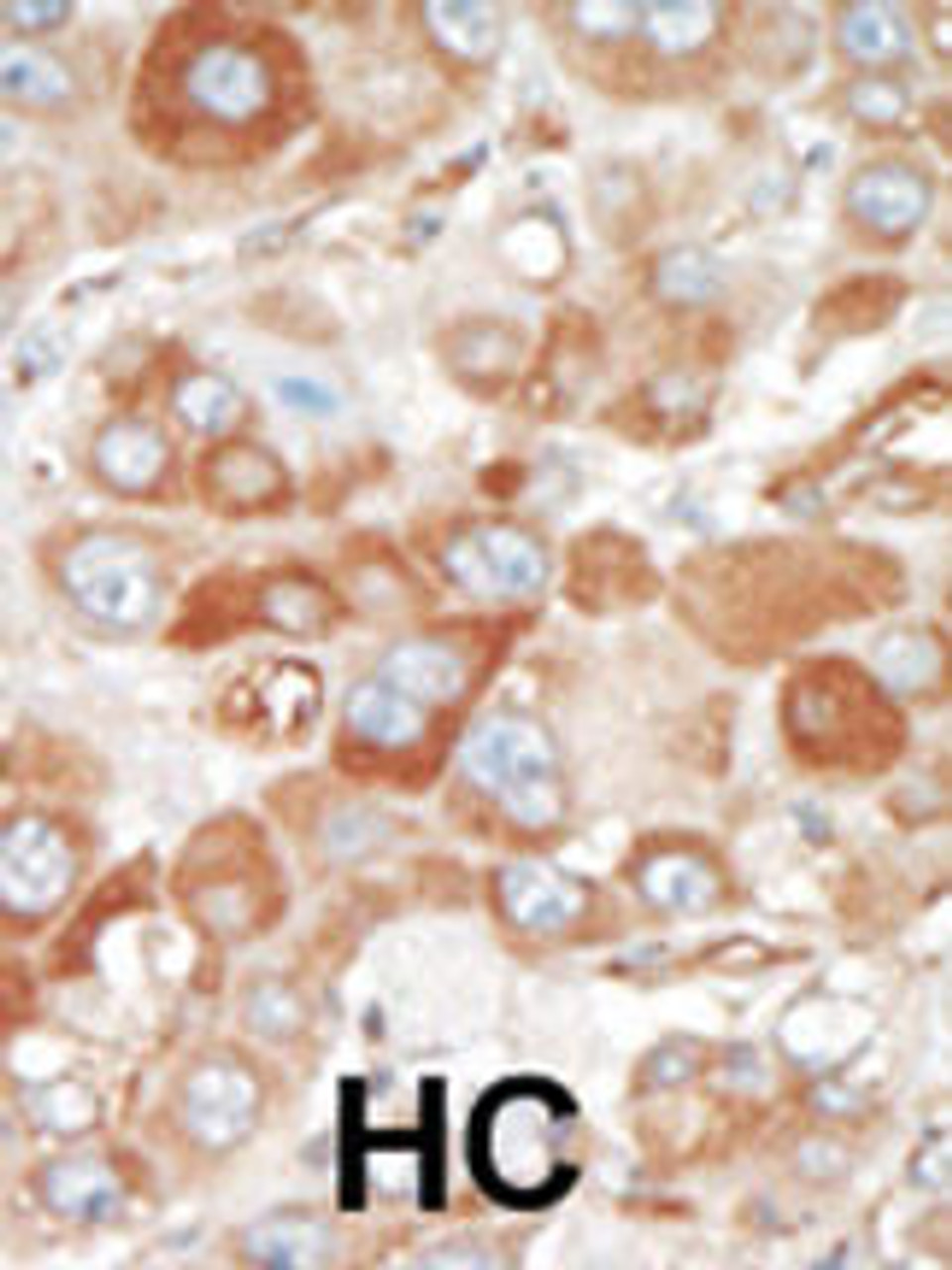 Formalin-fixed and paraffin-embedded human cancer tissue reacted with the primary antibody, which was peroxidase-conjugated to the secondary antibody, followed by DAB staining. BC = breast carcinoma; HC = hepatocarcinoma.