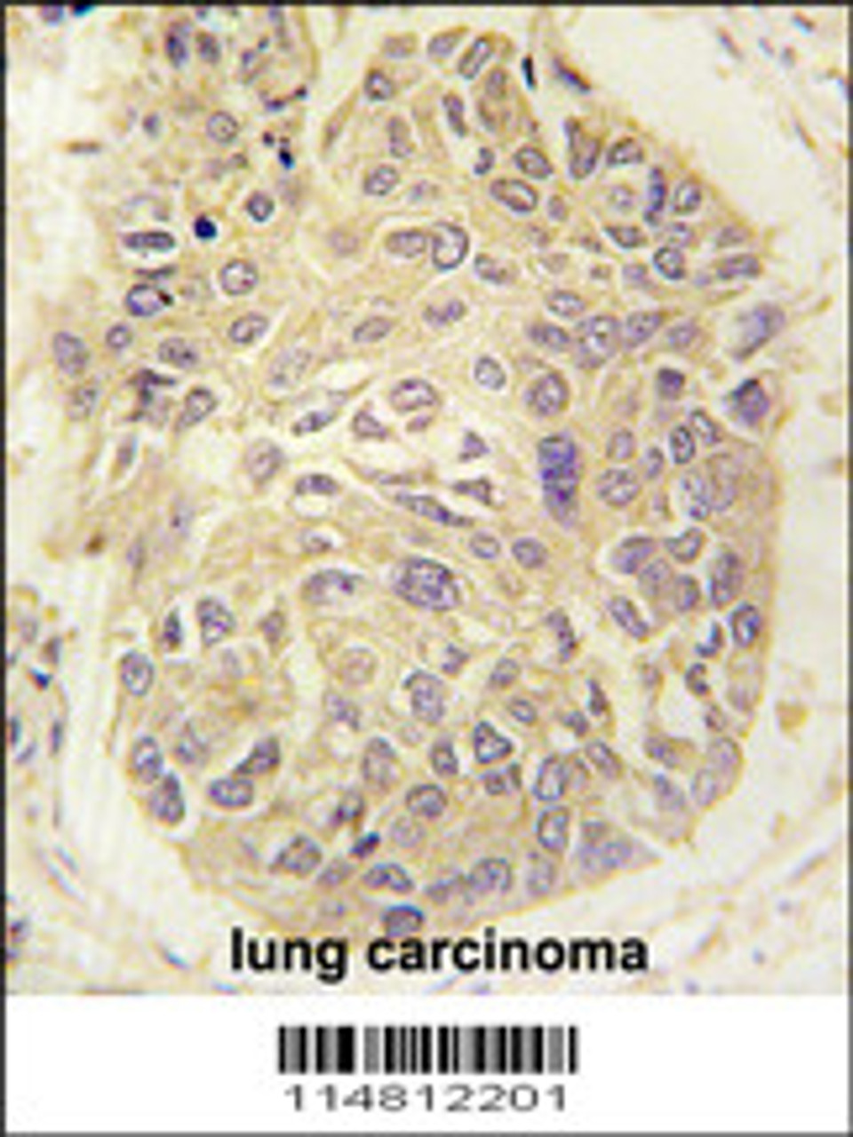 Formalin-fixed and paraffin-embedded human lung carcinoma tissue reacted with FARSA antibody, which was peroxidase-conjugated to the secondary antibody, followed by DAB staining.
