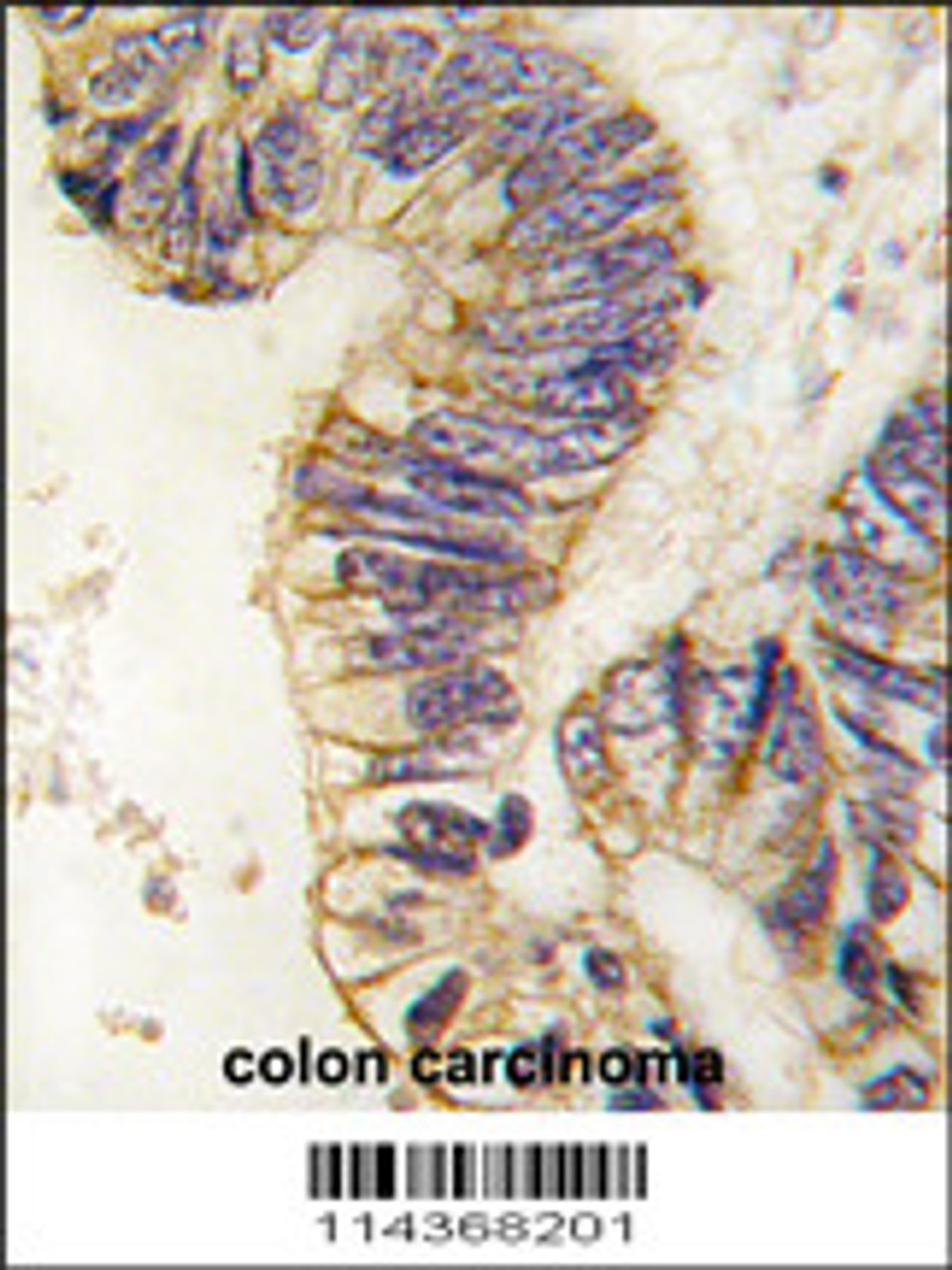 Formalin-fixed and paraffin-embedded human colon carcinoma tissue reacted with SRC1 antibody, which was peroxidase-conjugated to the secondary antibody, followed by DAB staining.