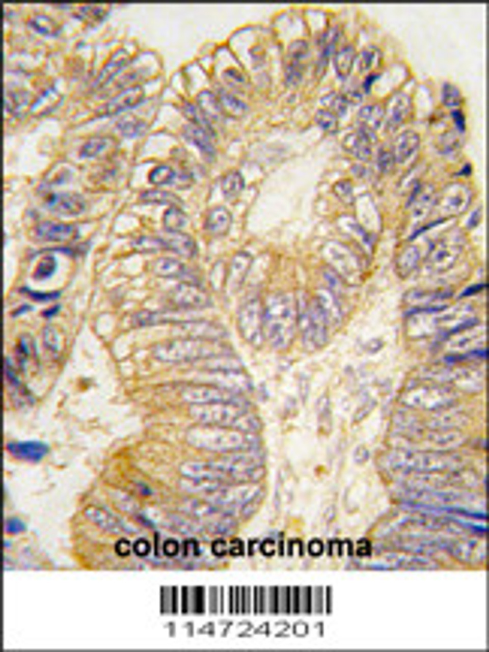 Formalin-fixed and paraffin-embedded human colon carcinoma tissue reacted with CLIC5 antibody, which was peroxidase-conjugated to the secondary antibody, followed by DAB staining.