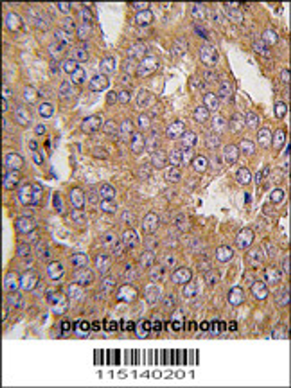 Formalin-fixed and paraffin-embedded human prostata carcinoma tissue reacted with NARS2 antibody, which was peroxidase-conjugated to the secondary antibody, followed by DAB staining.