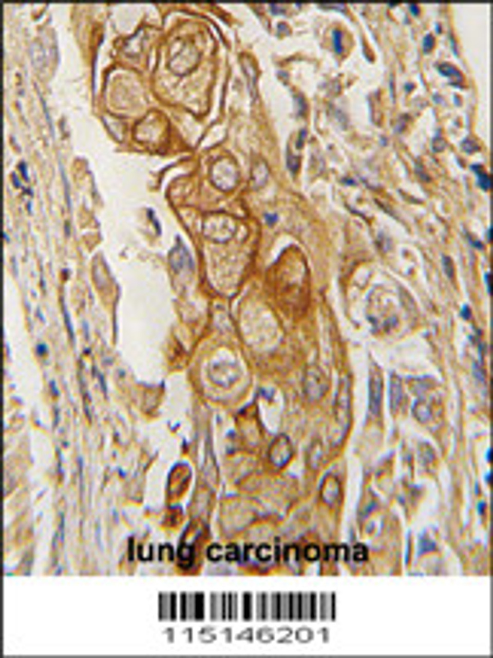 Formalin-fixed and paraffin-embedded human lung carcinoma tissue reacted with ACPP antibody, which was peroxidase-conjugated to the secondary antibody, followed by DAB staining.