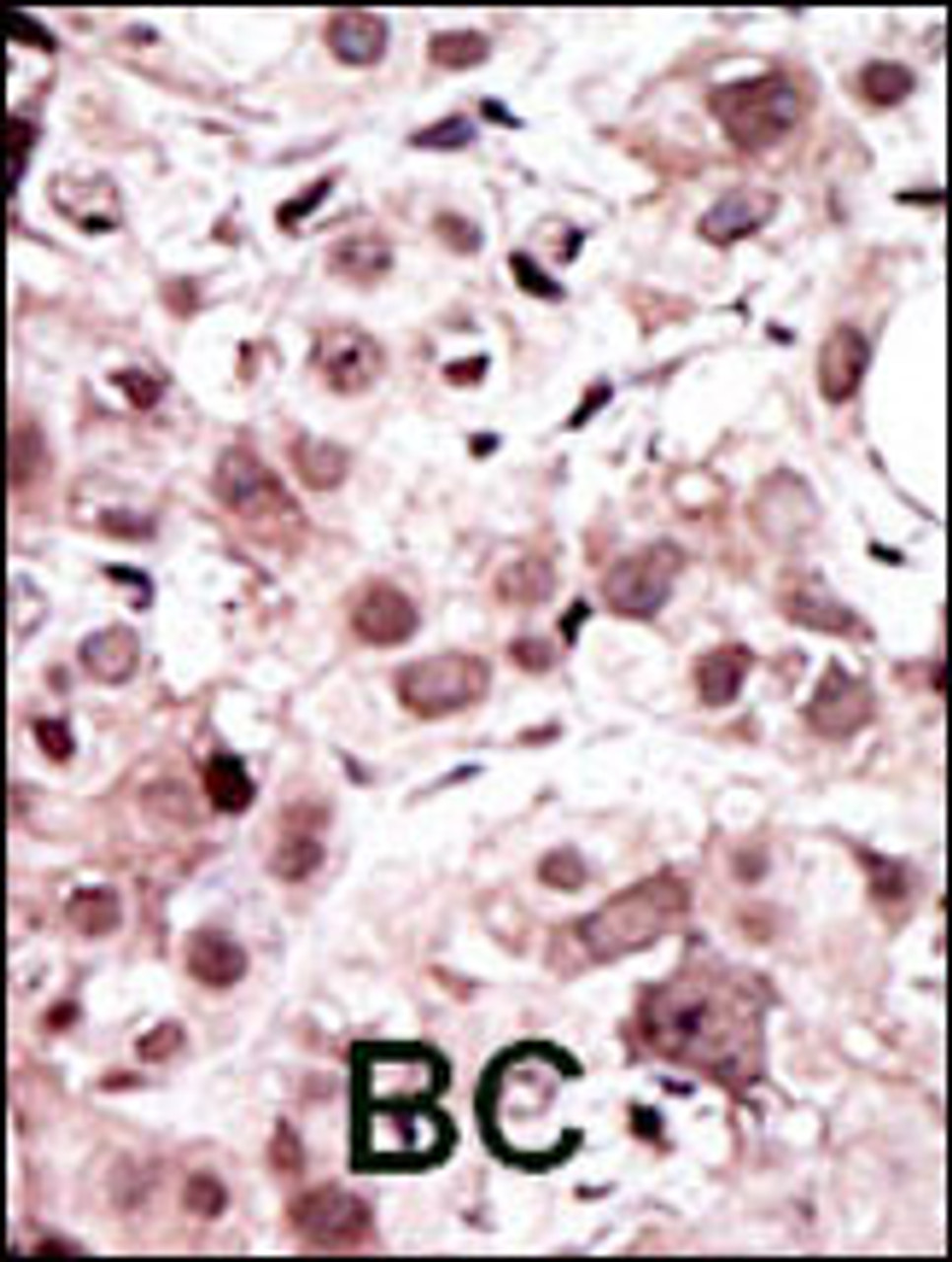 Formalin-fixed and paraffin-embedded human cancer tissue reacted with the primary antibody, which was peroxidase-conjugated to the secondary antibody, followed by AEC staining. BC = breast carcinoma; HC = hepatocarcinoma.