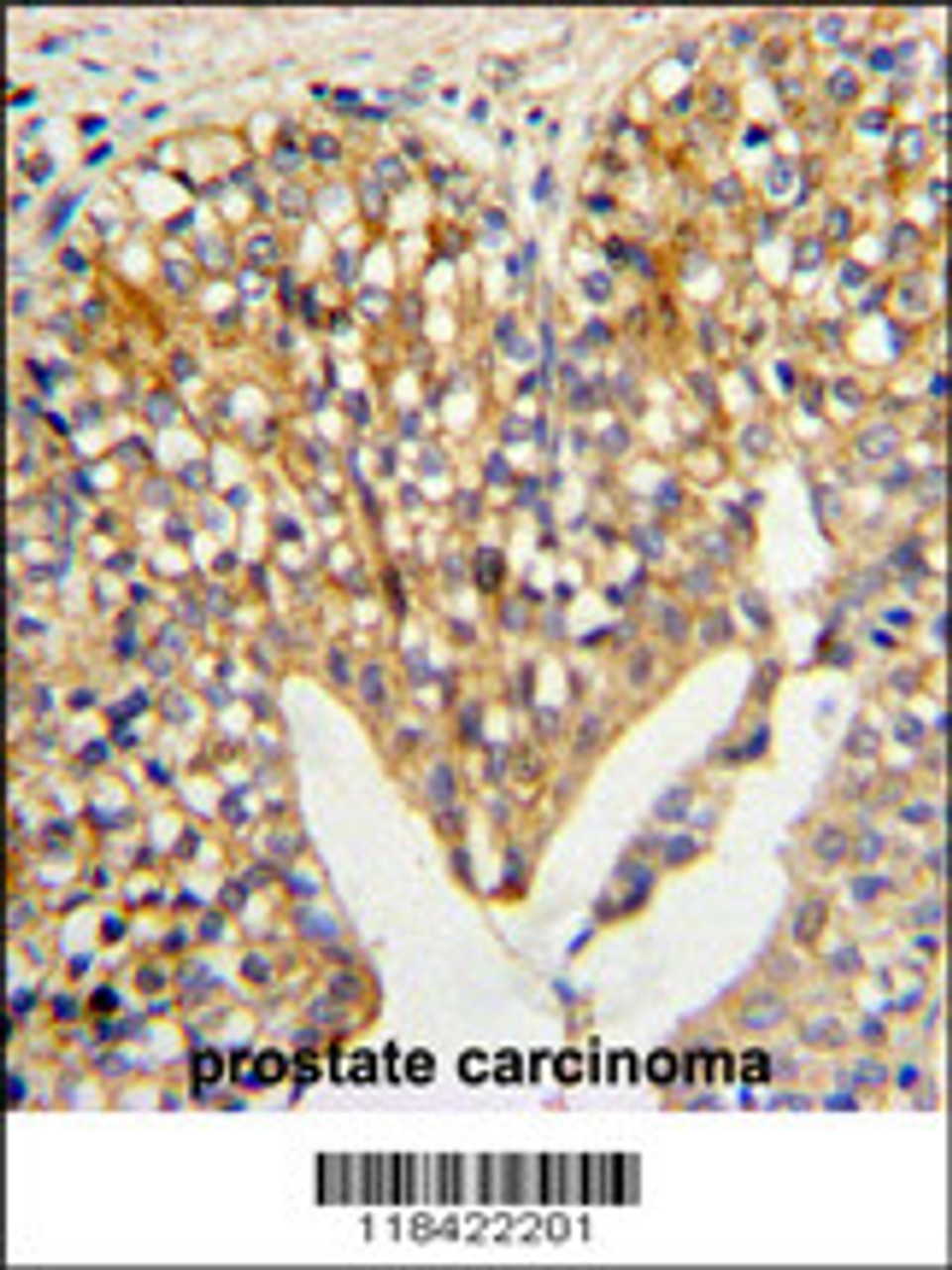 Formalin-fixed and paraffin-embedded human prostate carcinoma reacted with LUM Antibody (N-term) , which was peroxidase-conjugated to the secondary antibody, followed by DAB staining.