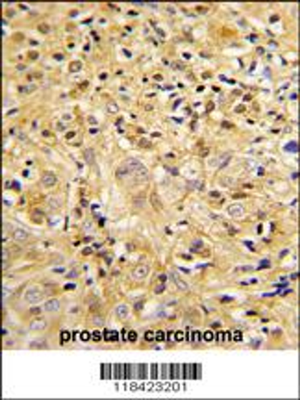 Formalin-fixed and paraffin-embedded human prostate carcinoma reacted with LUM Antibody, which was peroxidase-conjugated to the secondary antibody, followed by DAB staining.