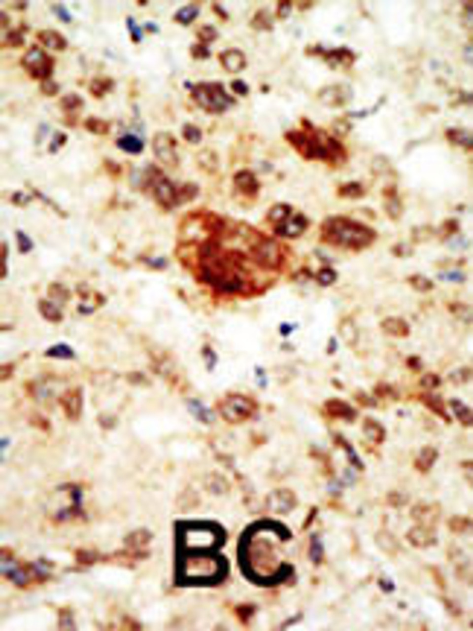 Formalin-fixed and paraffin-embedded human cancer tissue reacted with the primary antibody, which was peroxidase-conjugated to the secondary antibody, followed by AEC staining. BC = breast carcinoma; HC = hepatocarcinoma.