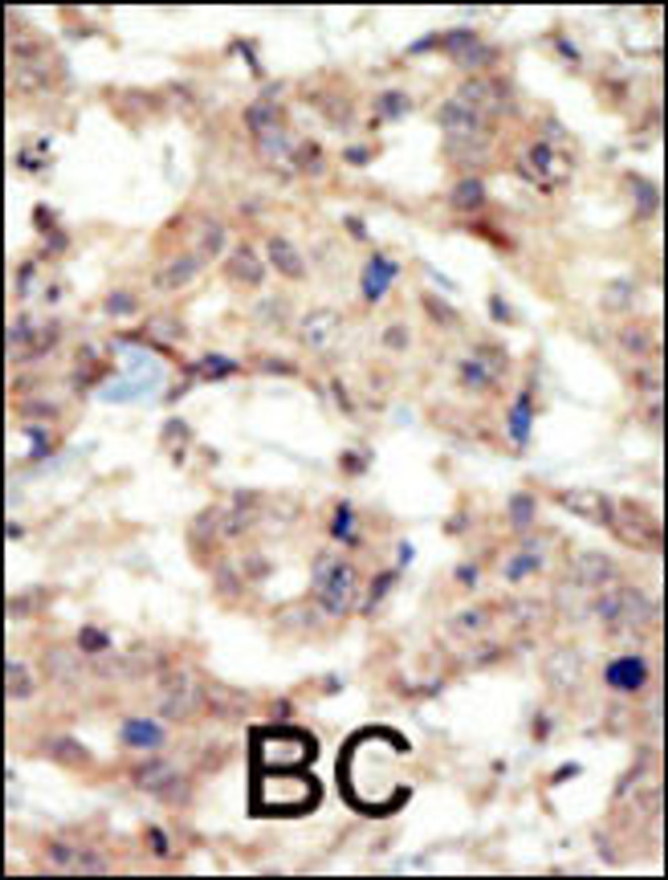 Formalin-fixed and paraffin-embedded human cancer tissue reacted with the primary antibody, which was peroxidase-conjugated to the secondary antibody, followed by DAB staining. BC = breast carcinoma; HC = hepatocarcinoma.