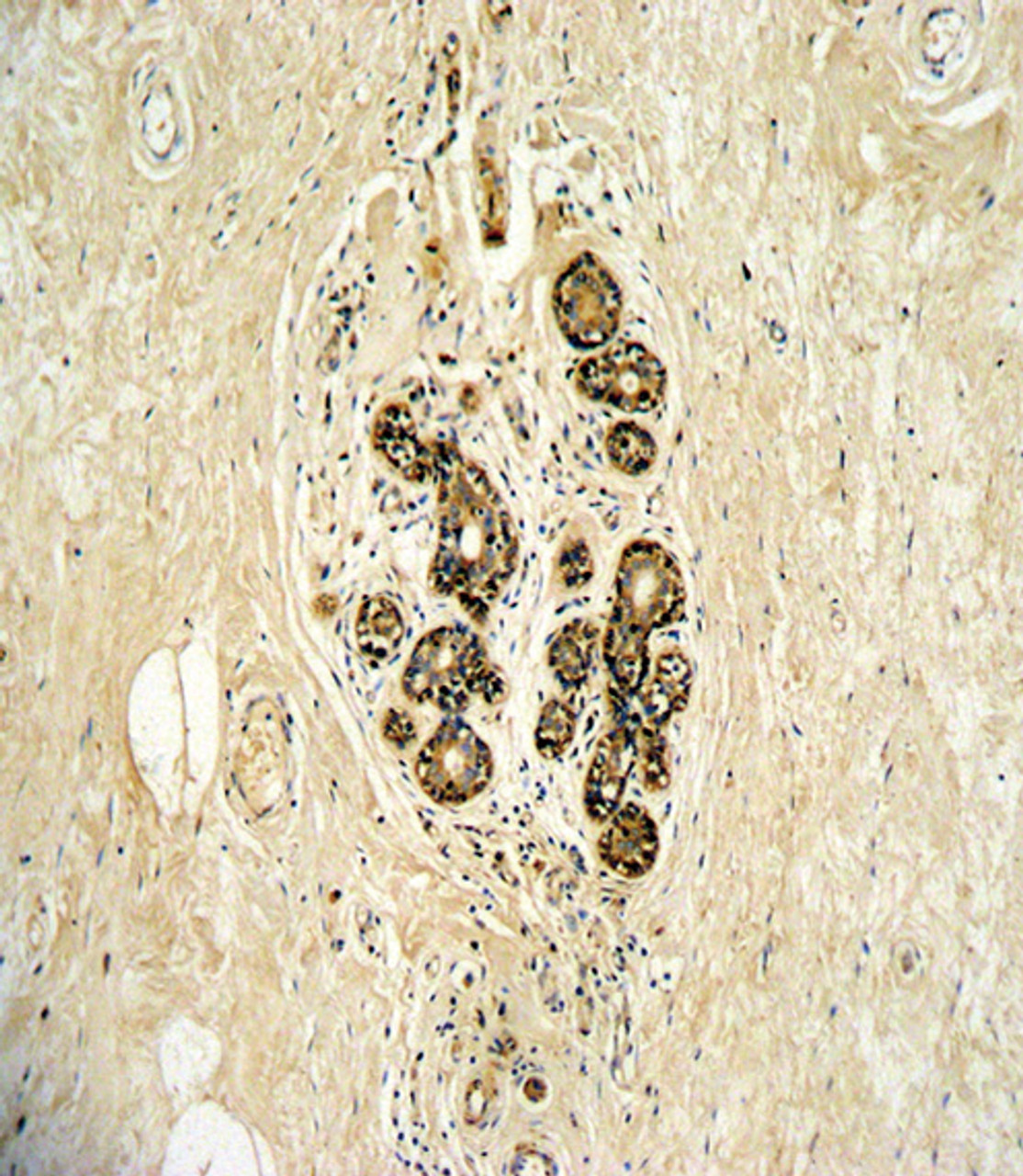 Formalin-fixed and paraffin-embedded human breast carcinoma with ErbB3 Antibody (N-term) , which was peroxidase-conjugated to the secondary antibody, followed by DAB staining.