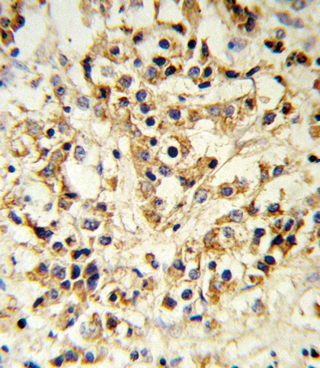 FGFR1 Antibody IHC analysis in formalin fixed and paraffin embedded human breast carcinoma followed by peroxidase conjugation of the secondary antibody and DAB staining.