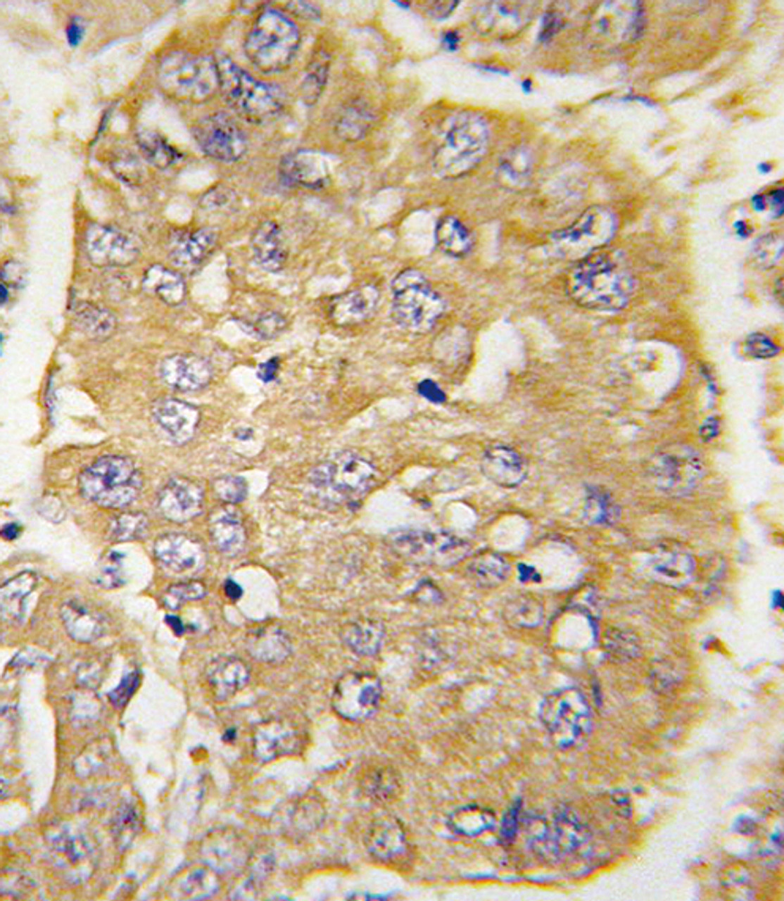 Formalin-fixed and paraffin-embedded human hepatocarcinoma tissue reacted with IGFBP3 Antibody, which was peroxidase-conjugated to the secondary antibody, followed by DAB staining.