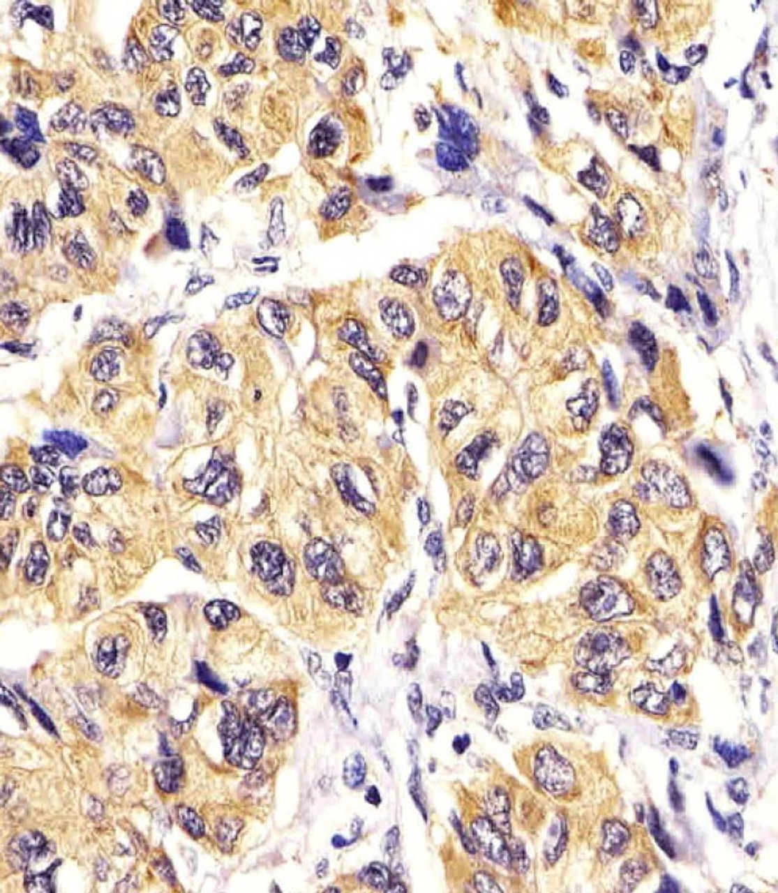 Antibody staining PDGFRA in Human hepatic carcinoma tissue sections by Immunohistochemistry (IHC-P - paraformaldehyde-fixed, paraffin-embedded sections) .