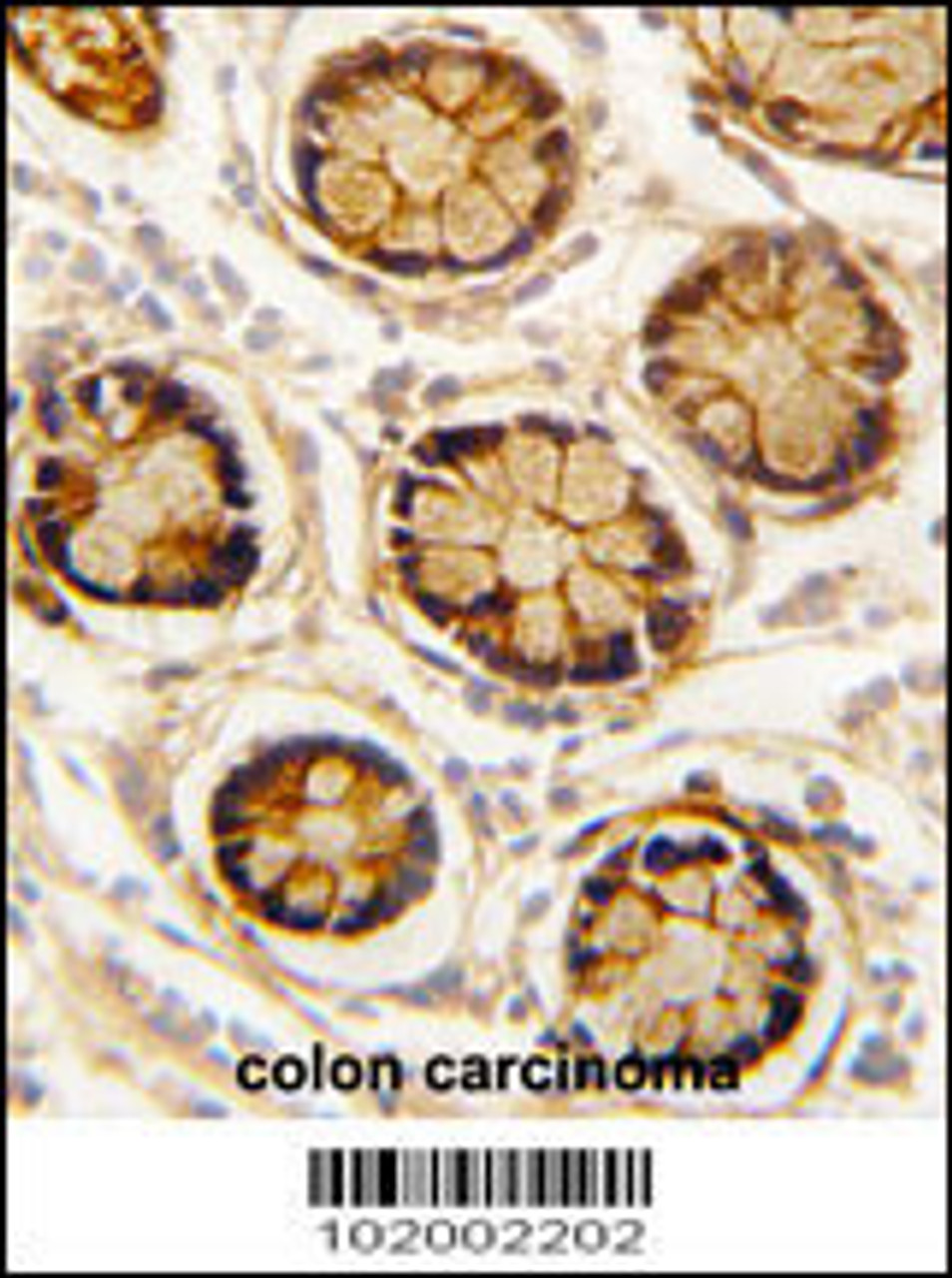 Formalin-fixed and paraffin-embedded human colon carcinoma reacted with PDGFRL antibody, which was peroxidase-conjugated to the secondary antibody, followed by DAB staining.