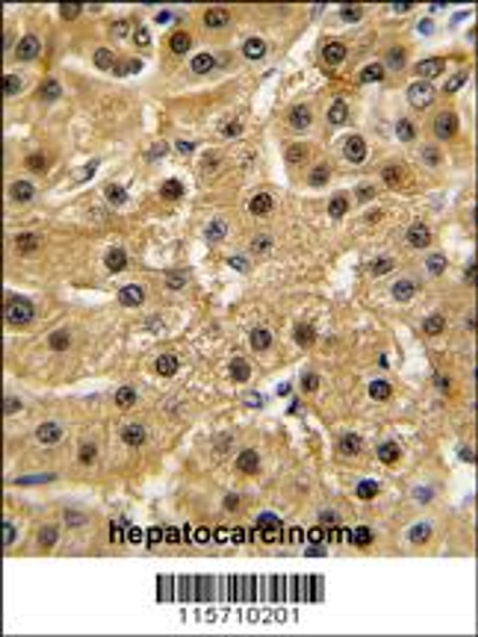 Formalin-fixed and paraffin-embedded human hepatocarcinoma tissue reacted with ABL1 antibody, which was peroxidase-conjugated to the secondary antibody, followed by DAB staining.