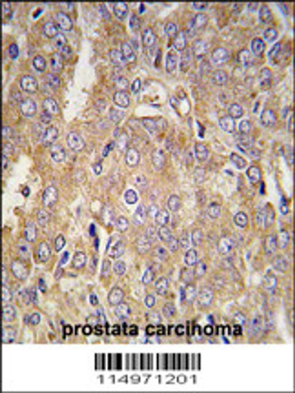 Formalin-fixed and paraffin-embedded human prostata carcinoma tissue reacted with LTBP1 antibody, which was peroxidase-conjugated to the secondary antibody, followed by DAB staining.