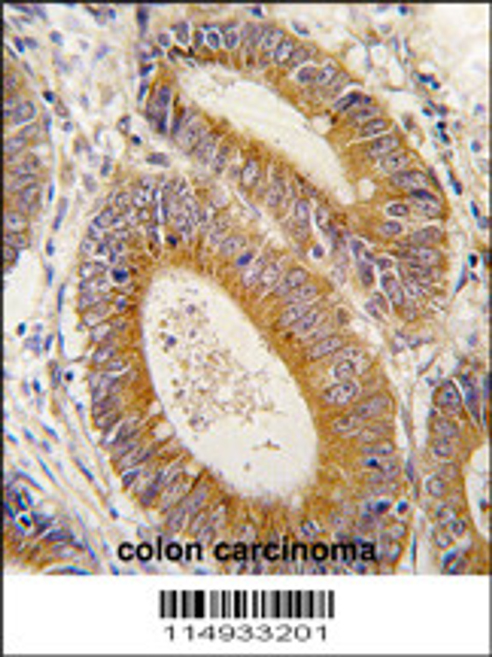 Formalin-fixed and paraffin-embedded human colon carcinoma tissue reacted with YARS2 antibody, which was peroxidase-conjugated to the secondary antibody, followed by DAB staining.