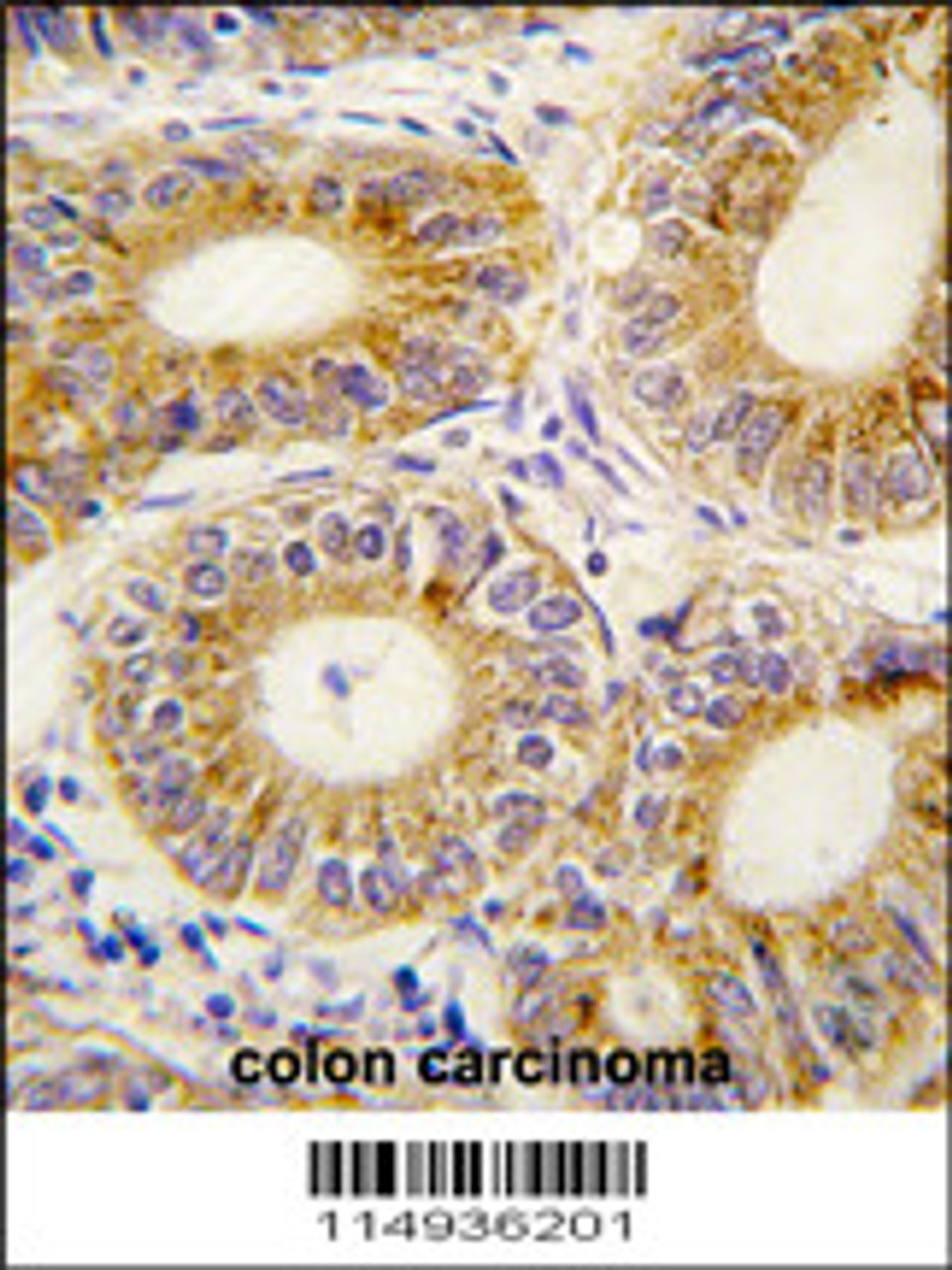 Formalin-fixed and paraffin-embedded human colon carcinoma tissue reacted with YARS2 antibody, which was peroxidase-conjugated to the secondary antibody, followed by DAB staining.