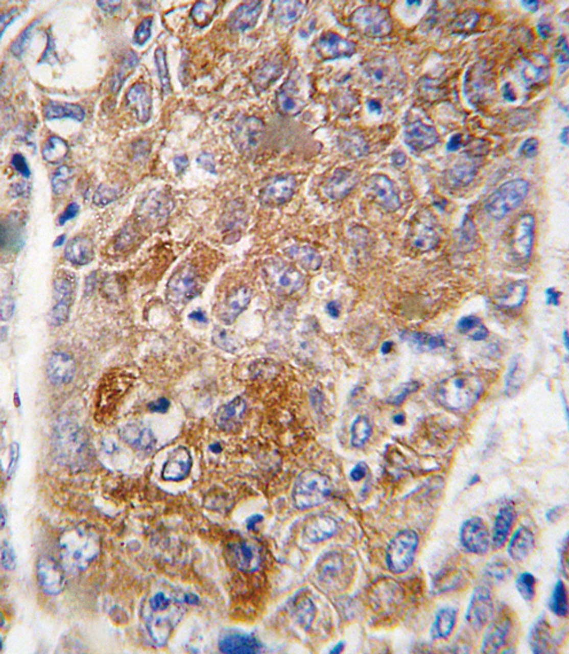 Formalin-fixed and paraffin-embedded human hepatocarcinoma tissue reacted with ALDH1L1 antibody, which was peroxidase-conjugated to the secondary antibody, followed by DAB staining.