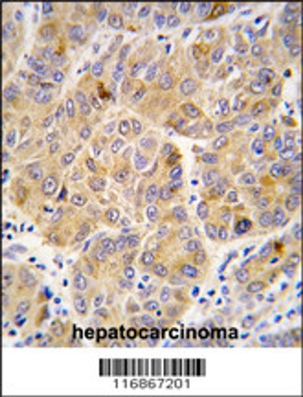 Formalin-fixed and paraffin-embedded human hepatocarcinoma tissue reacted with ALDH9A1 antibody, which was peroxidase-conjugated to the secondary antibody, followed by DAB staining.